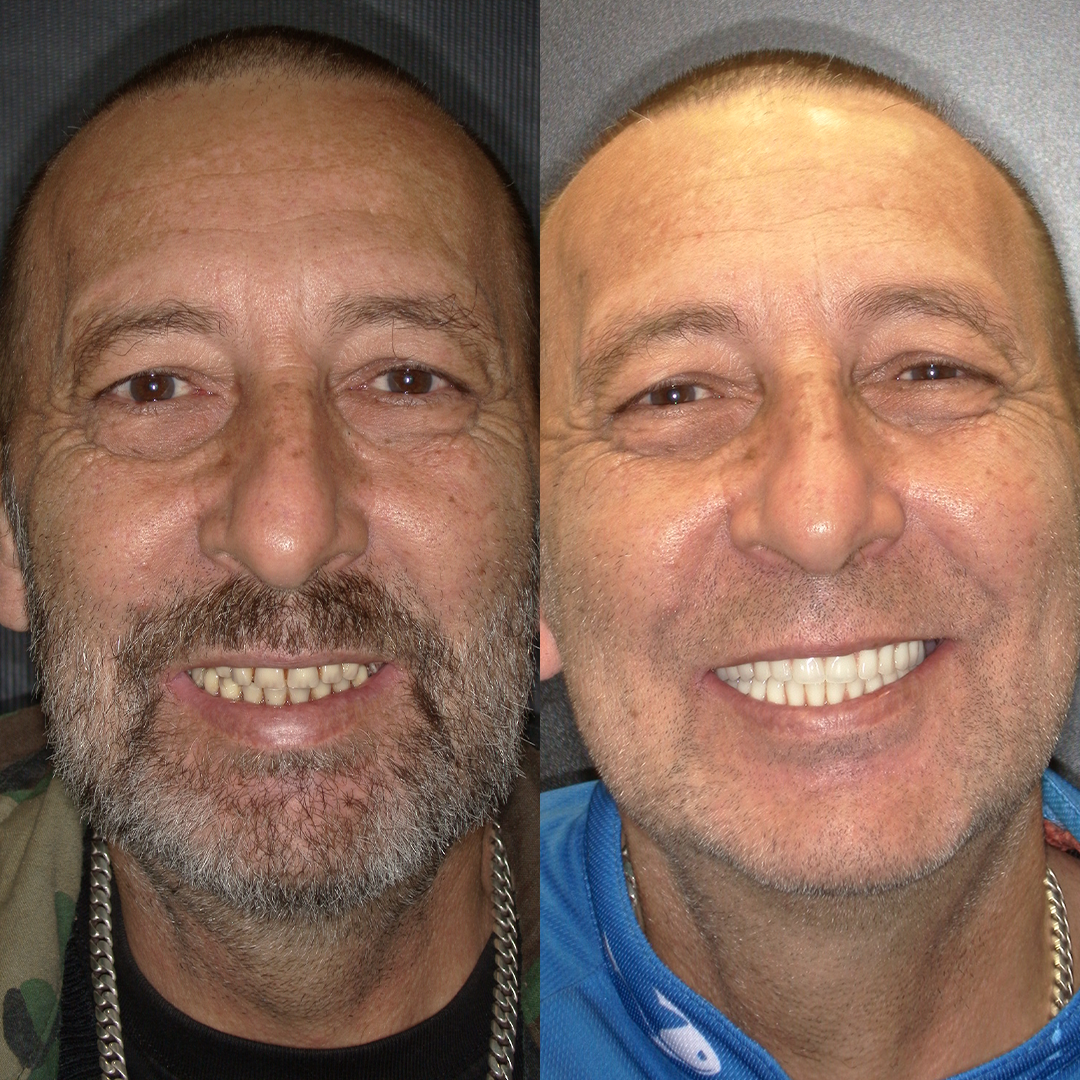 Caso real de implante protocolo, antes e depois
